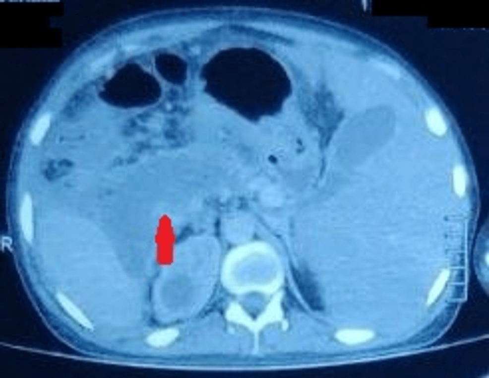 Computed-tomography-of-the-abdomen-showing-situs-inversus-with-necrotic-collection-(red-arrow)-in-the-pancreas
