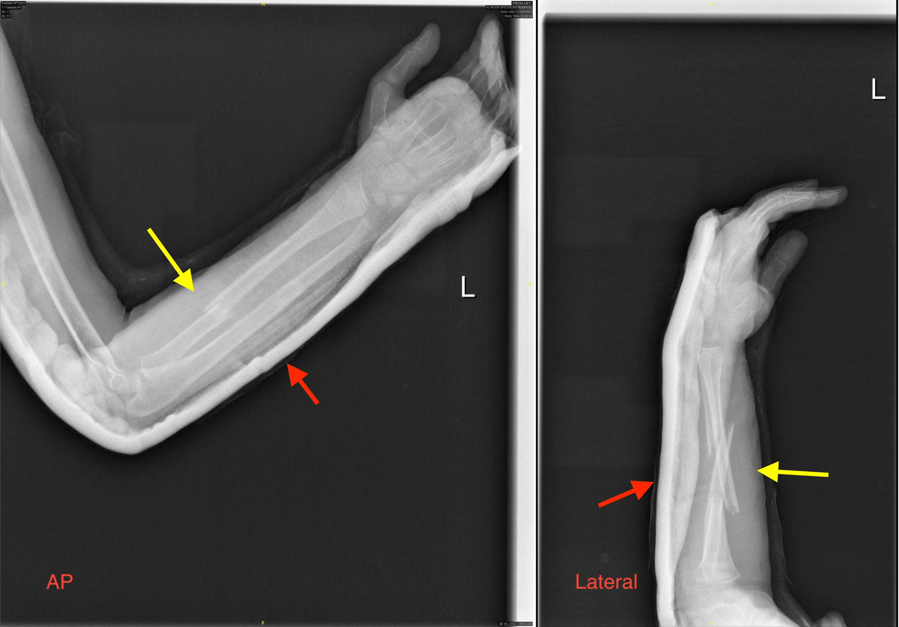 Greenstick Fractures Of The Mid- Radial And Ulnar Diaphysis With Volar ...