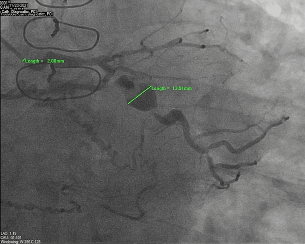 Coronary-angiography-shows-a-large-fusiform-aneurysm-of-the-left-circumflex-artery-(13.91-mm)-with-adjacent-proximal-and-mid-stenosis.-The-catheter-diameter-(2-mm)-is-shown-in-comparison-to-the-aneurysm-size---