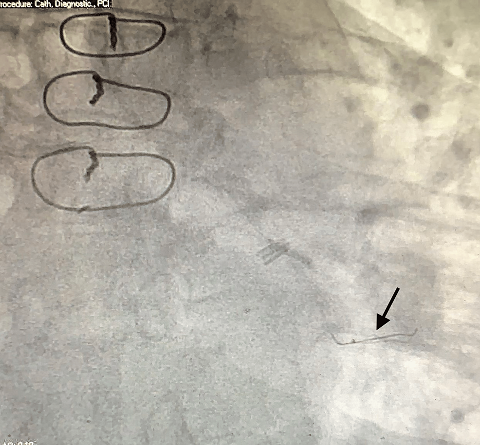 Coronary-angiography-showing-that-the-guidewire-is-now-parked-more-distally-(black-arrow)