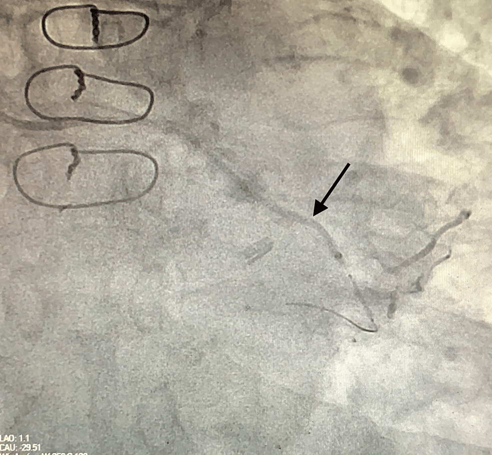 Coronary-angiography-showing-guide-extension-catheter-(arrow)-used-for-the-smooth-delivery-of-the-covered-stent