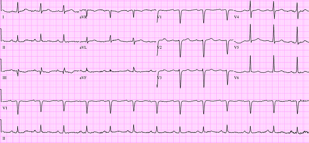 Cureus | A Rare Desmoglein-2 Gene Mutation in Arrhythmogenic Right ...