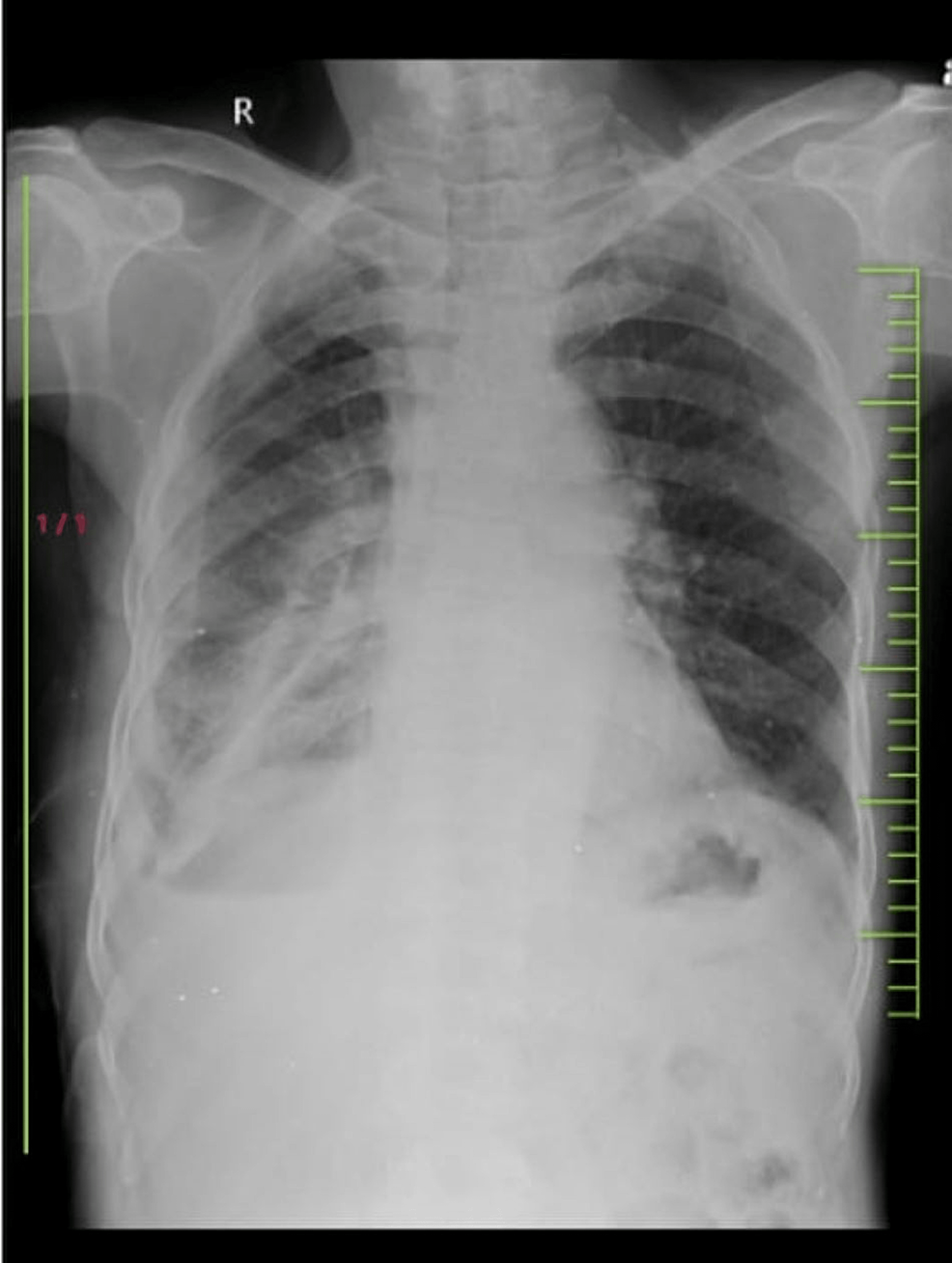 Chest-X-ray-of-the-patient-(posteroanterior-view).