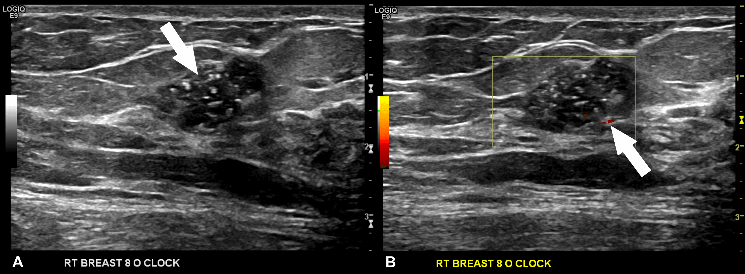 Cureus Intracystic Papillary Carcinoma A Case Report