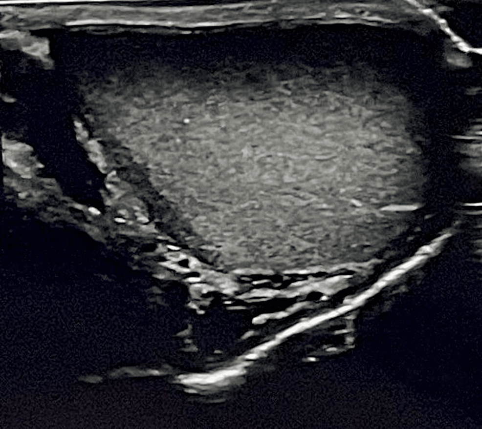 cureus-liposarcoma-of-the-spermatic-cord-mimicking-an-inguinal-hernia