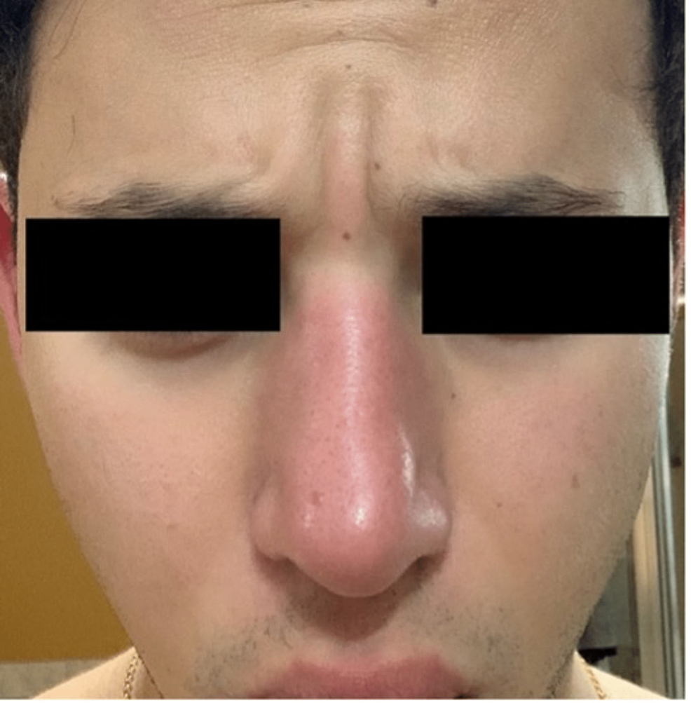 cureus-a-unique-case-of-facial-hypervascularity-responding-to-pulsed