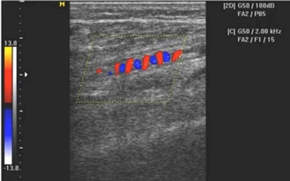 Cureus | An Unusual Case of Buerger’s Disease in a Pregnant Female