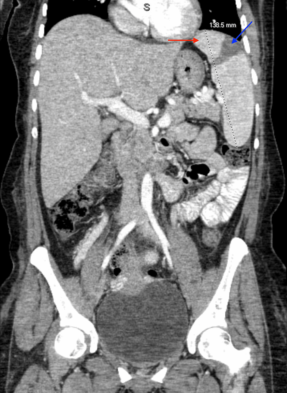 Cureus | A Case of Malaria-Associated Hemophagocytic Lymphohistiocytosis