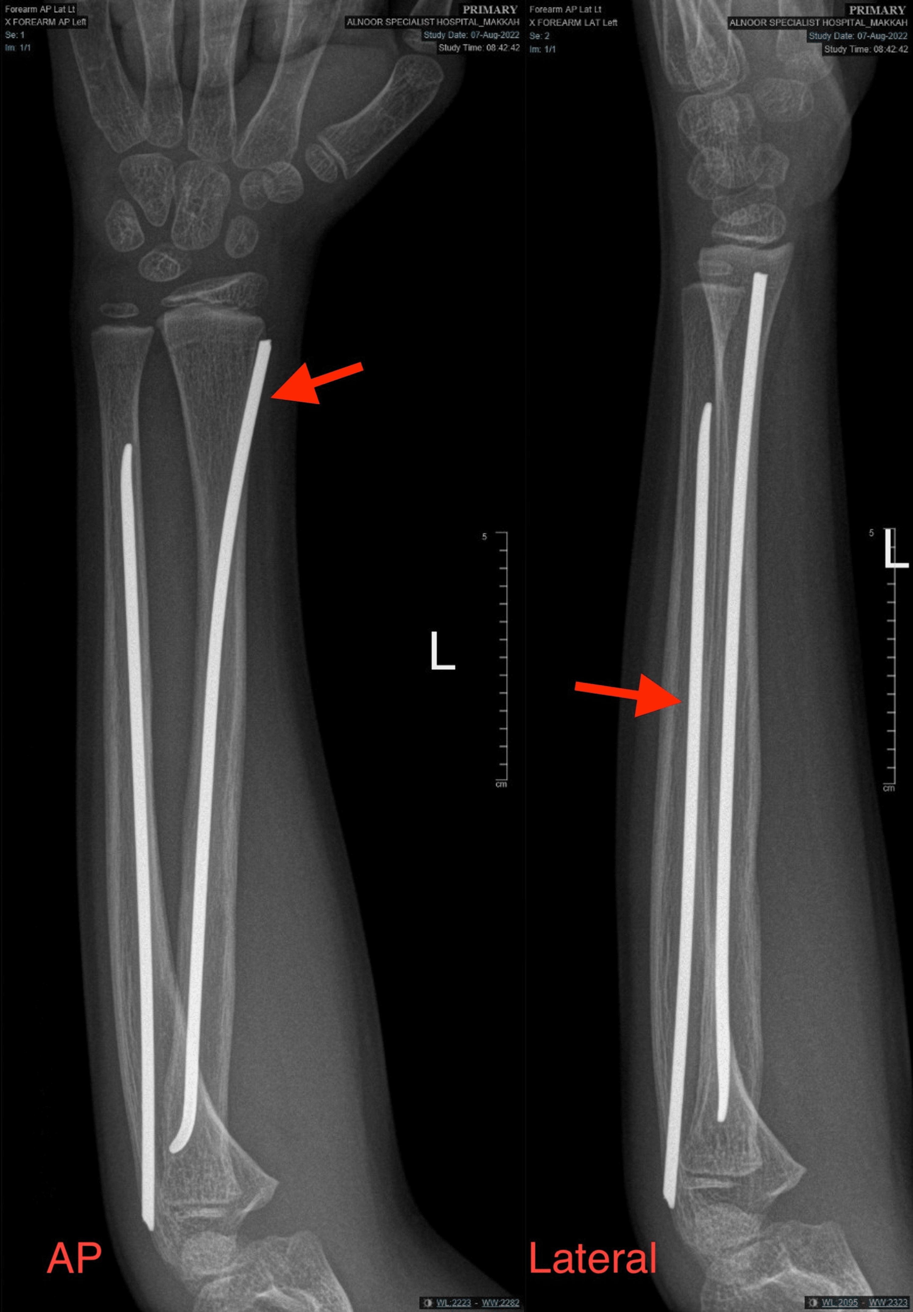 broken forearm recovery