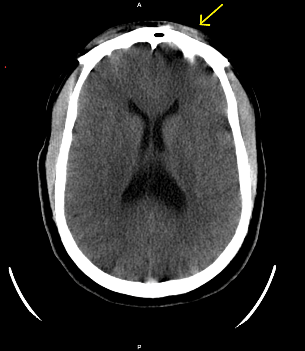 CT-head-shows-a-mild-left-frontal-subcutaneous-soft-tissue-swelling-suggestive-of-a-contusion-or-hematoma.