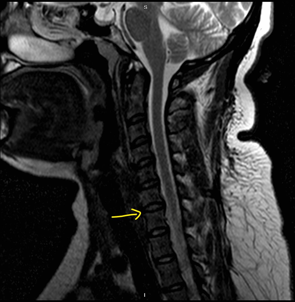 MRI-of-the-cervical-spine-shows-a-small-central-disc-protrusion-between-C4-and-C5.