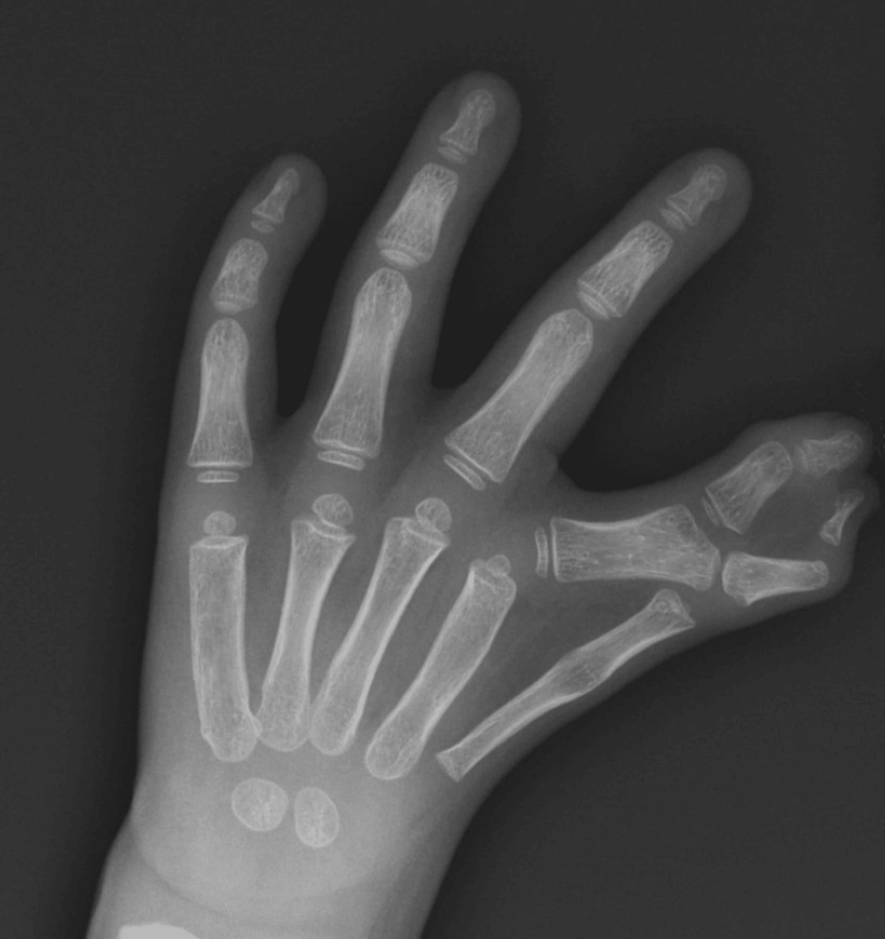 Cureus | Super Digit: More Than a Complicated Syndactyly