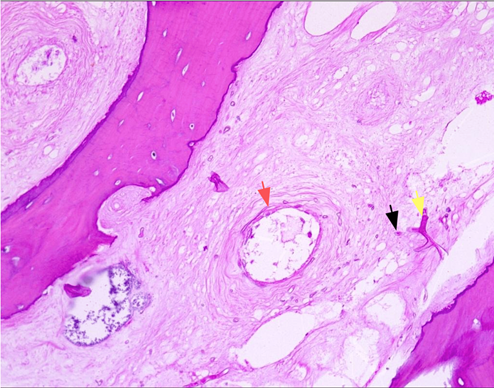 Microscopic-image-of-the-specimen-taken-intraoperatively-showing-the-presence-of-Mucor-spores-(black-arrow)-and-mycelium-(yellow-arrow)-with-evidence-of-angioinvasion-(red-arrow).