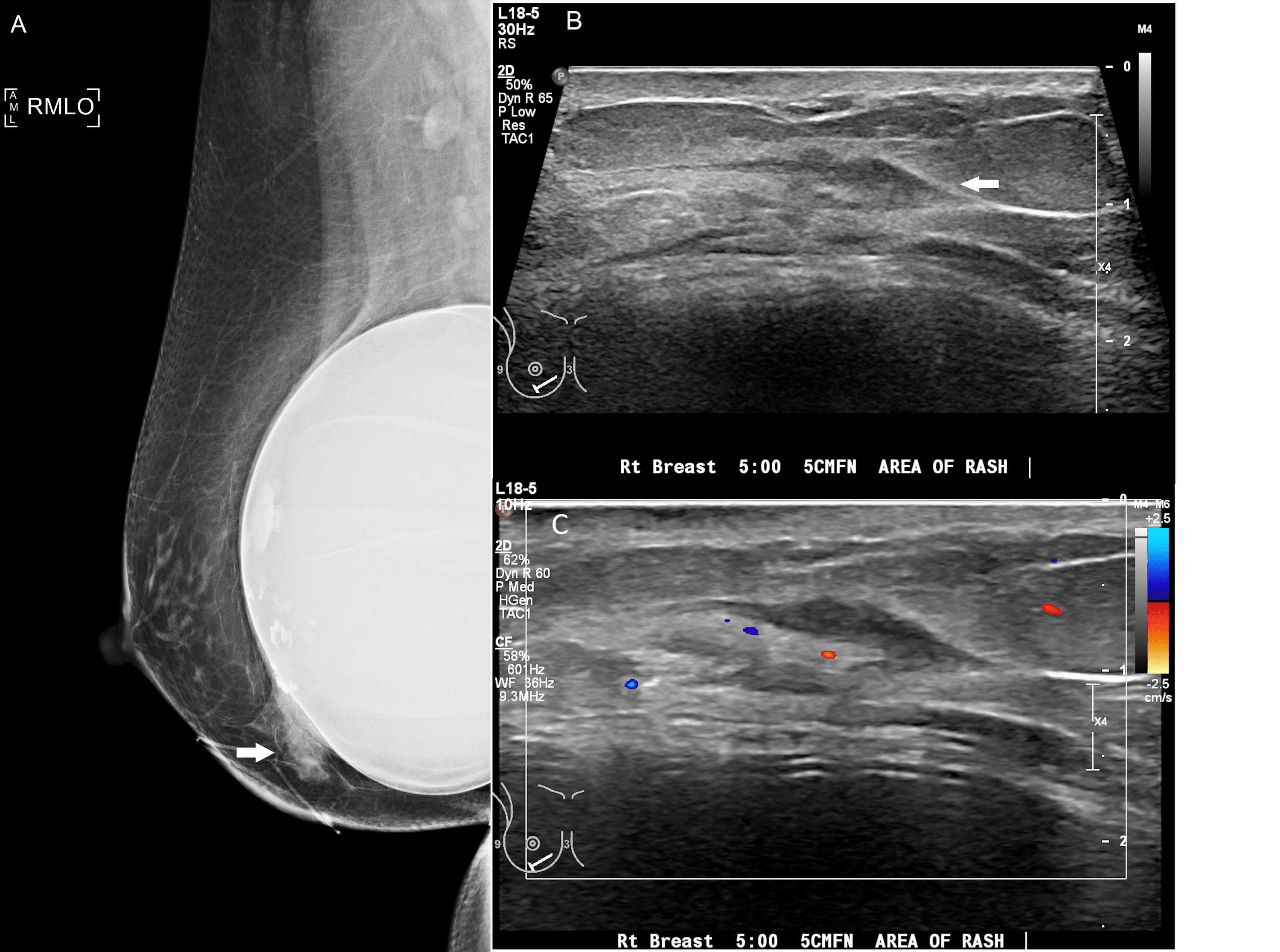 cureus-arthropod-bite-mastitis-as-a-mimicker-of-breast-cancer