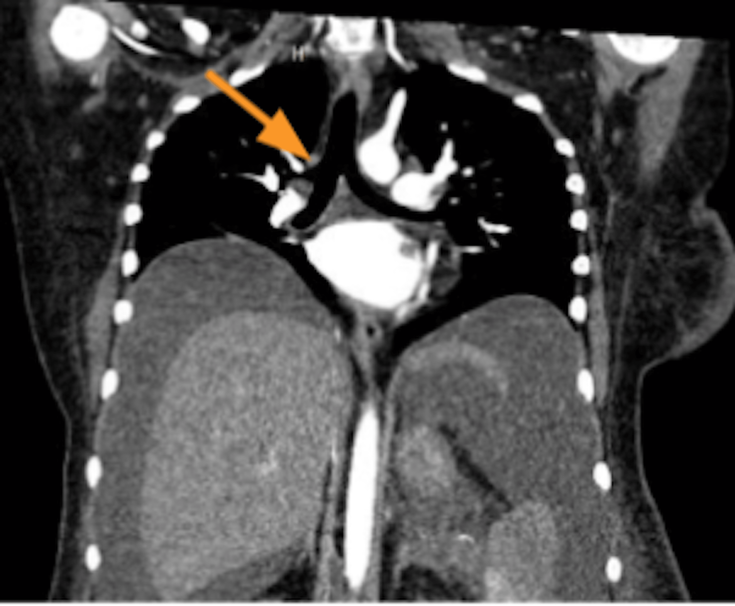 Intraoperative Diagnosis of "Bronchus Suis", a Variant of Tracheal