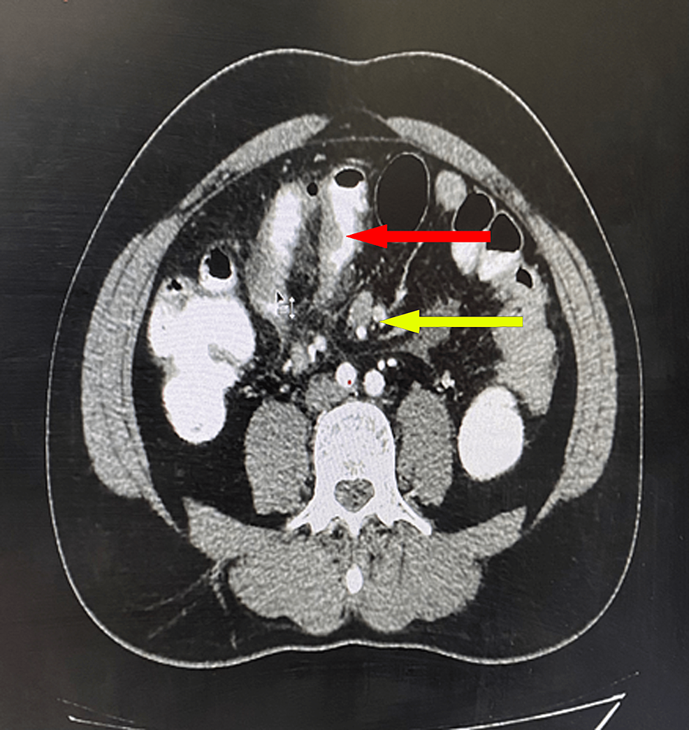 Post-contrast-phase-axial-CT-showing-long-segment-edematous-thickening-of-the-mid-ileal-loop-with-surrounding-fat-stranding-(shown-in-red-arrow),-multiple-enlarged-mesenteric-lymph-nodes-(shown-by-the-yellow-arrow),-and-fluid-and-adjacent-extra-luminal-air