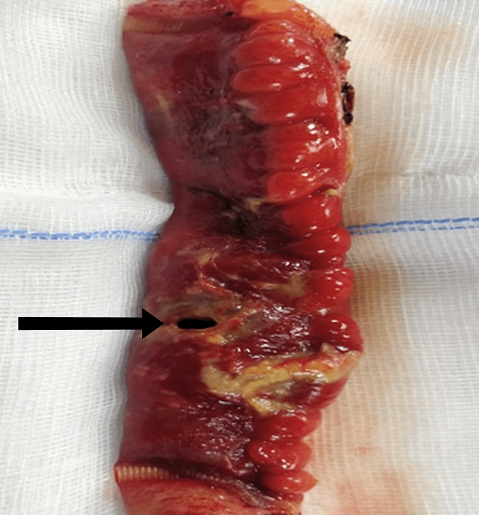 Gross-photograph-showing-the-resected-specimen-of-ileum-with-the-perforation-site-(shown-in-black-arrow)-and-adjacent-areas-of-necrosis