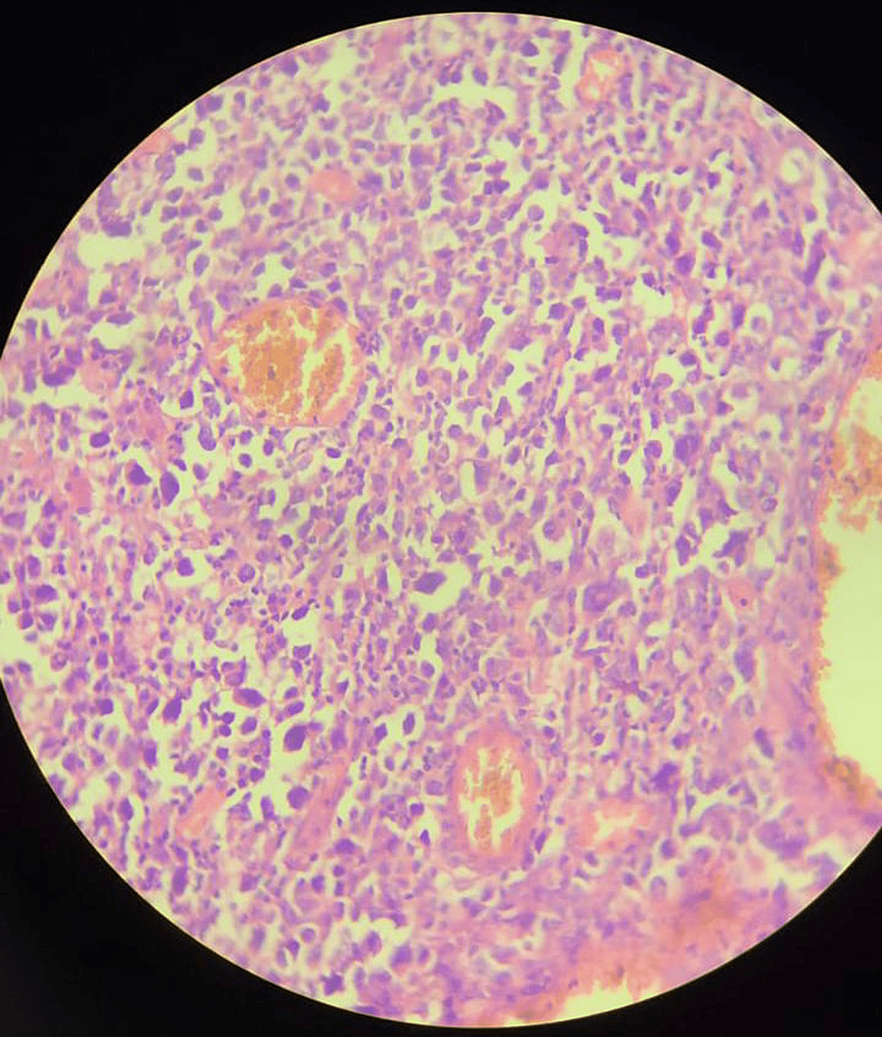 Biopsy-of-the-ileum-shows-a-submucosal-lymphoid-neoplasm-composed-of-a-polymorphous-population-of-cells-consisting-of-centrocytes,-centroblasts,-atypical-lymphoid-cells-with-the-intended-nucleus-with-basophilic-cytoplasm-and-perinuclear-clear-Golgi-zone-seen.-Hallmark-cells-with-an-eccentric-horseshoe-shaped-nucleus-and-occasional-doughnut-cells-were-noted.