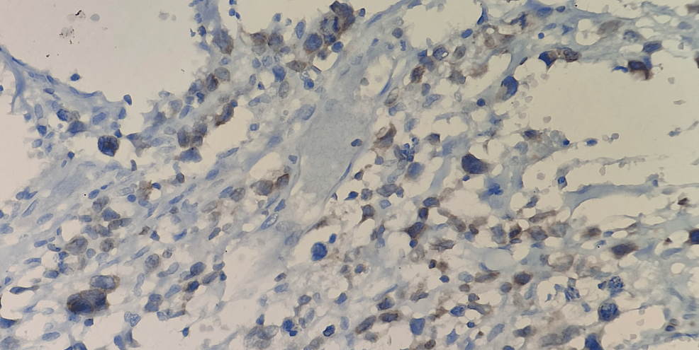 Immunostains-showing-the-cells-are-positive-for-CD3-(400-x)