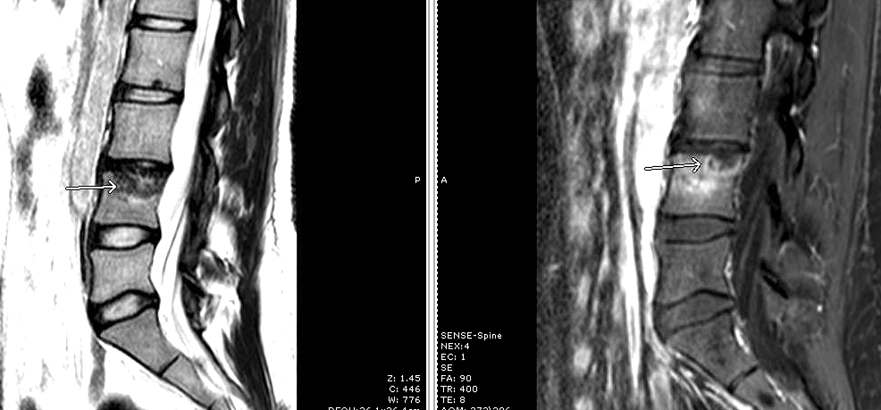 Initial-MRI-lumbar-spine