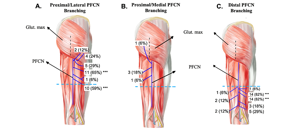 lateral femoral cutaneous nerve dermatome