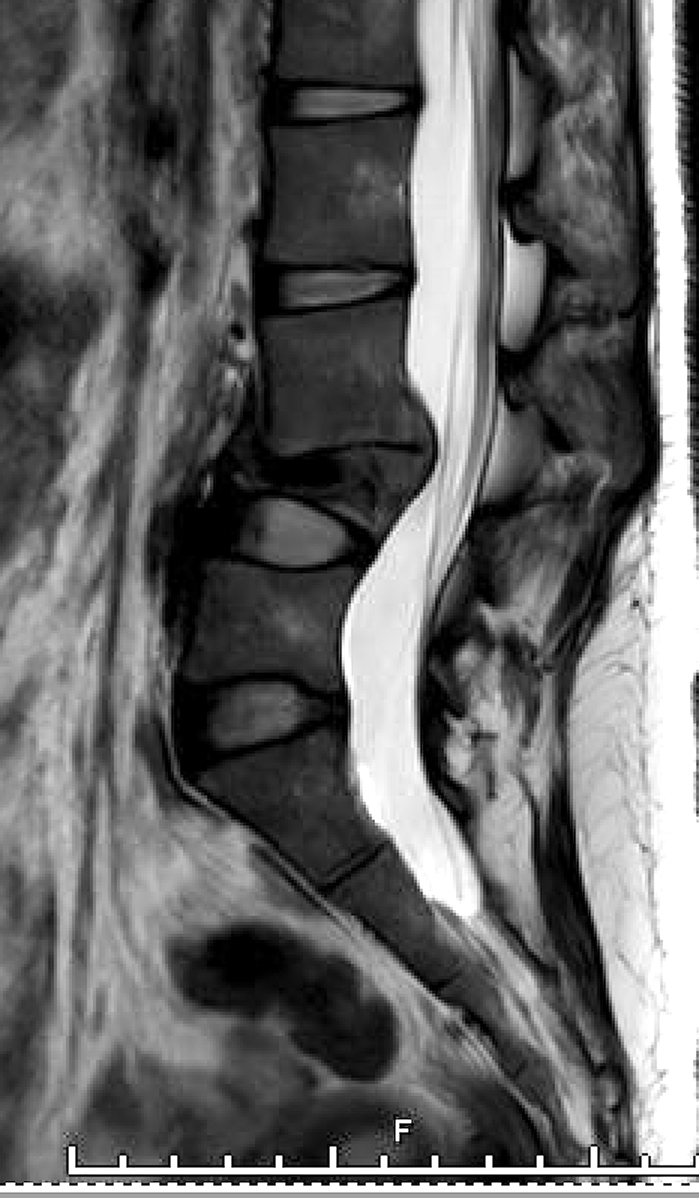 Lumbar-MRI-with-new-deformity