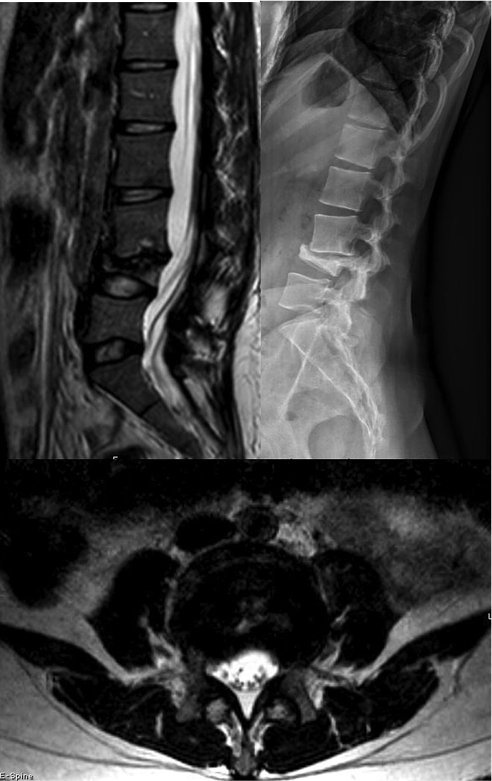 MRI-thoracic-spine-and-thoracic-spine-radiograph