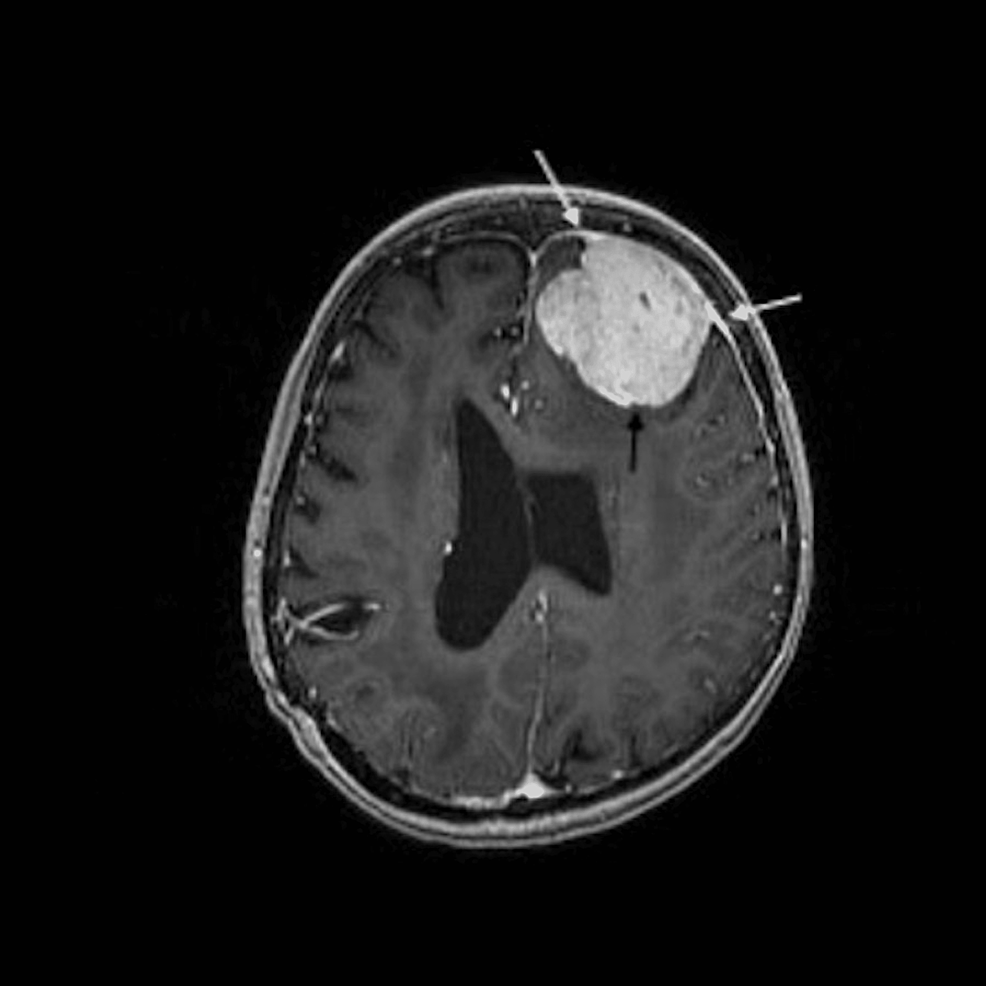 A-T1-weighted-post-gadolinium-axial-MRI-showing-a-2.5cm,-homogeneously-enhancing-meningioma-(black-arrow)-with-enhancing-dural-tails-(white-arrows).