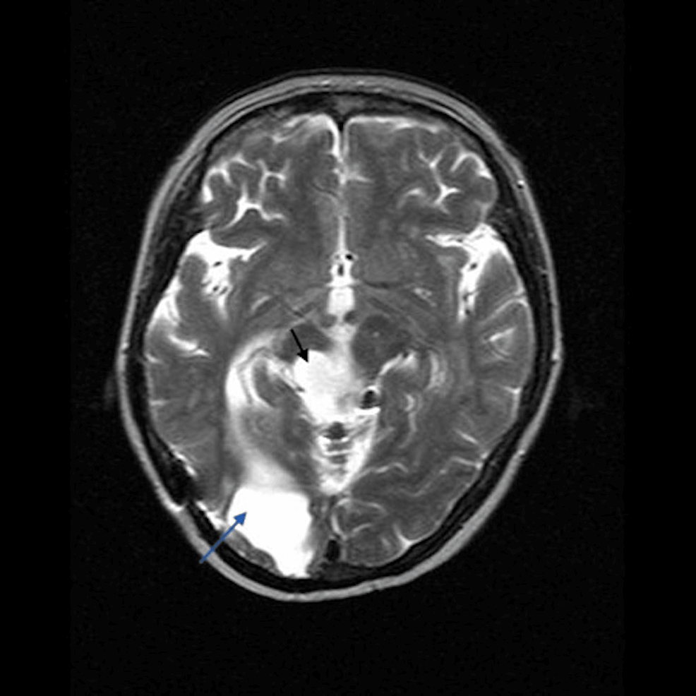 T2-weighted-axial-MRI-showing-cystic-encephalomalacia-in-the-right-parietal/occipital-region-(grey-arrow)-in-keeping-with-remote-surgery-for-a-glioblastoma,-with-additional-post-surgical-changes-in-the-region-of-the-midbrain-(black-arrow).