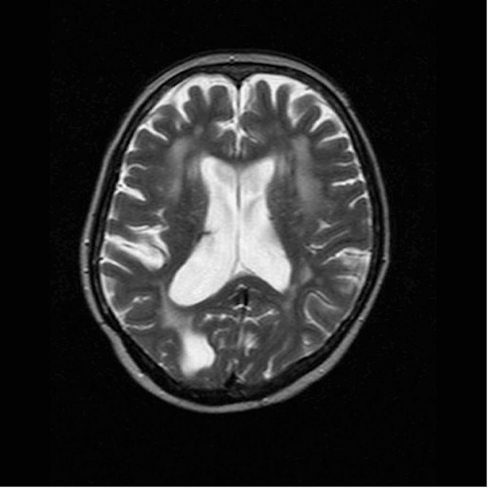 T2-weighted-MRI-showing-ventriculomegaly-and-prominent-sulci-present-in-an-ex-vacuo-fashion,-with-extensive-white-matter-disease-throughout-the-supratentorial-white-matter-related-to-previous-glioblastoma-treatment.