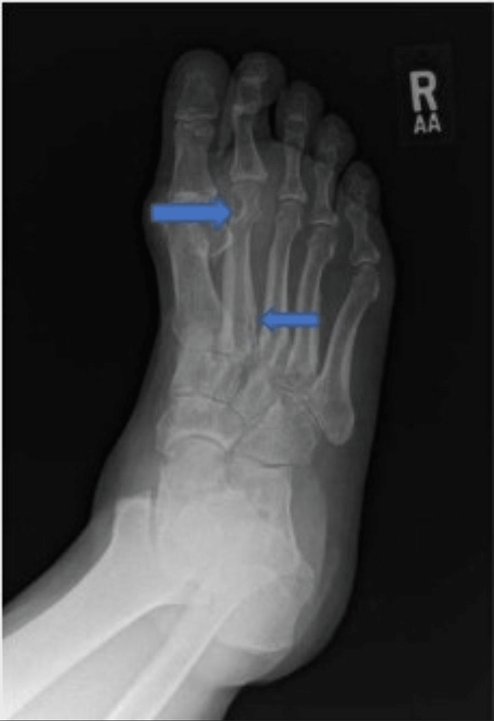 cureus-a-case-report-of-successful-management-of-refractory