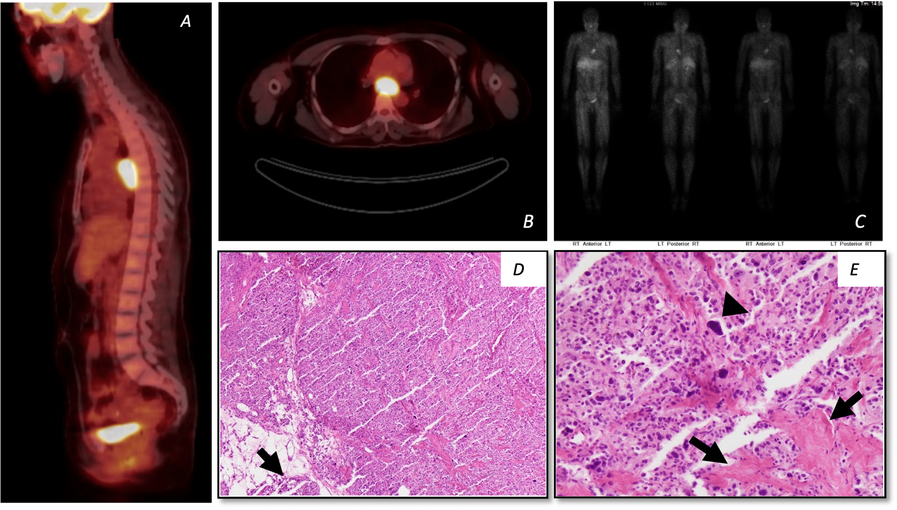 Cureus A Study of Paraganglioma Cases With NonEuropean Ancestry