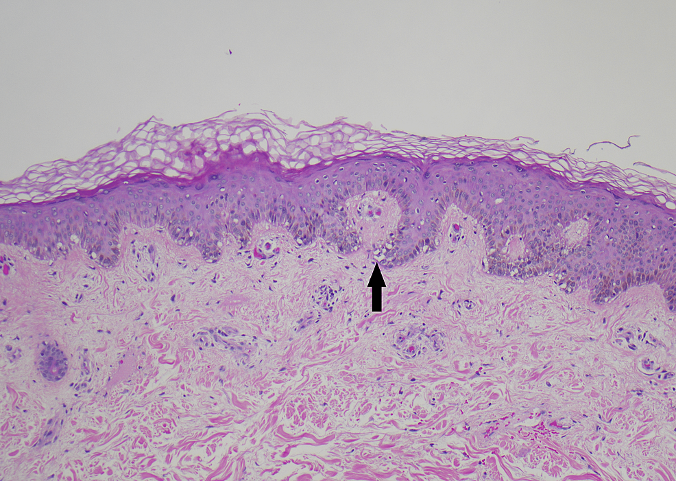Low-magnification-view-of-epidermis-demonstrating-basovacular-changes-at-the-dermal-epidermal-junction-(arrow).-(hematoxylin-and-eosin,-100x-magnification).