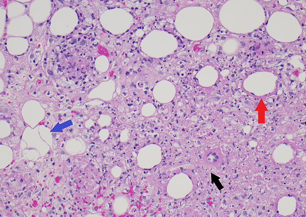 Several-histologic-features-of-lupus-panniculitis-are-observed,-including-neutrophil-rich-infiltrate-(black-arrow),-hyalinization-of-fat-globules-(red-arrow),-and-variable-adipocyte-size-(blue-arrow).-(hematoxylin-and-eosin,-200x-magnification).