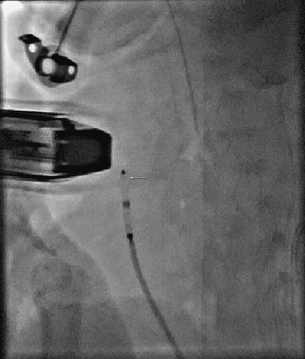 Cureus Transcatheter Closure of a Patent Ductus Arteriosus Using a