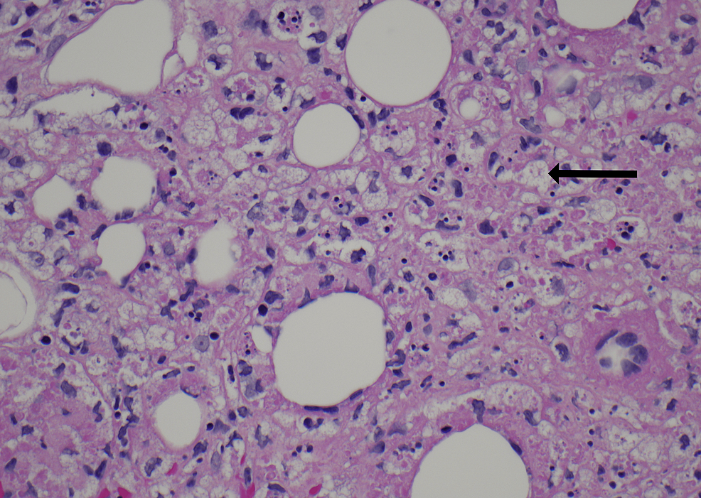 Diffuse-fat-necrosis-of-the-subcutaneous-tissue-with-clusters-of-histiocytes-showing-phagocytosis-of-red-cells,-white-cells,-and-nuclear-debris-(arrow).-(hematoxylin-and-eosin,-400x-magnification)