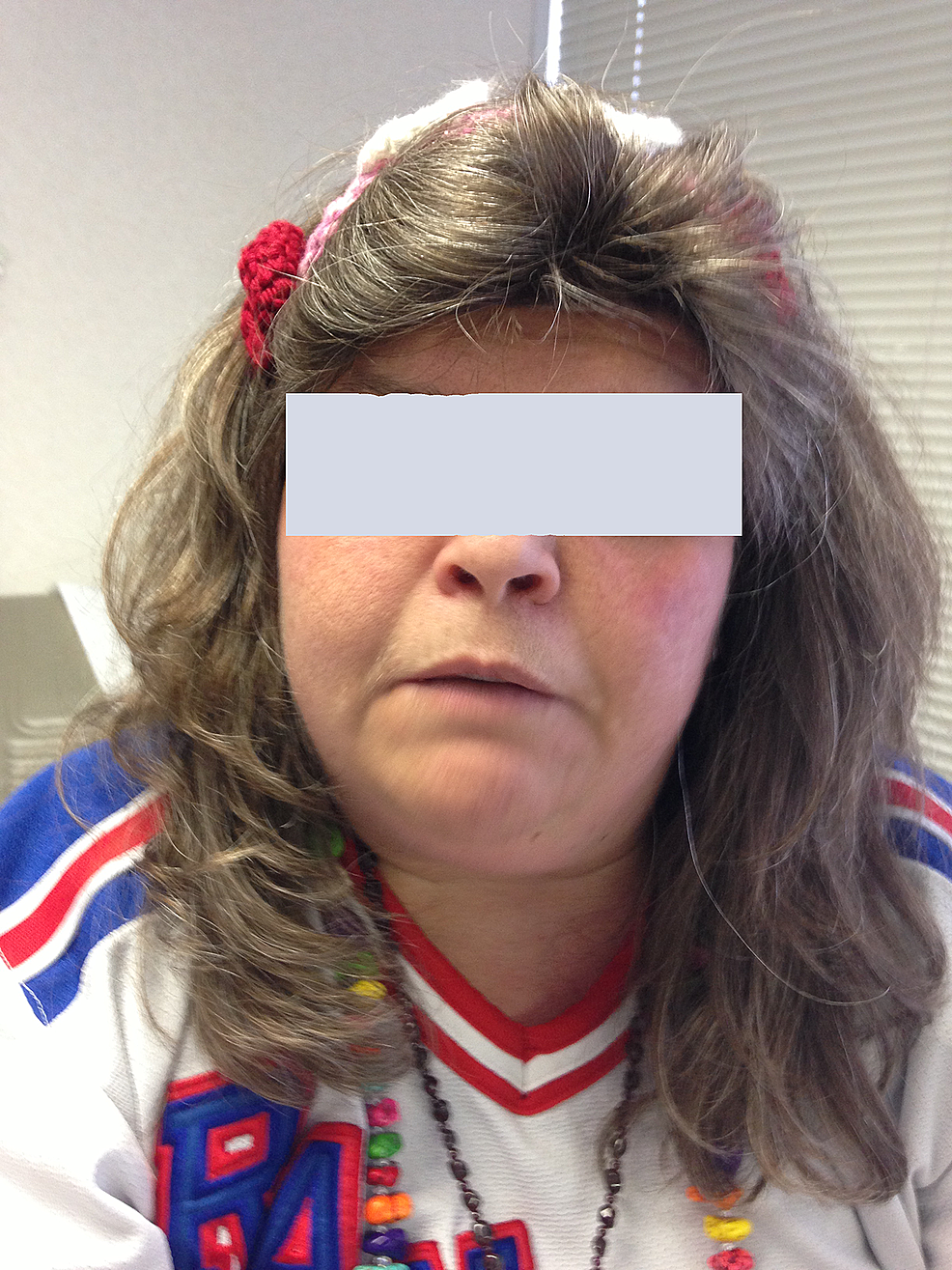 Cureus Brachydactyly Mental Retardation Syndrome Diagnosed in Adulthood