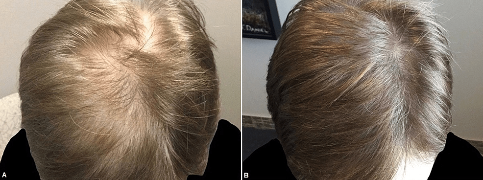 Male-patient-before-(A)-and-one-month-after-three-platelet-rich-plasma-treatments-(B)