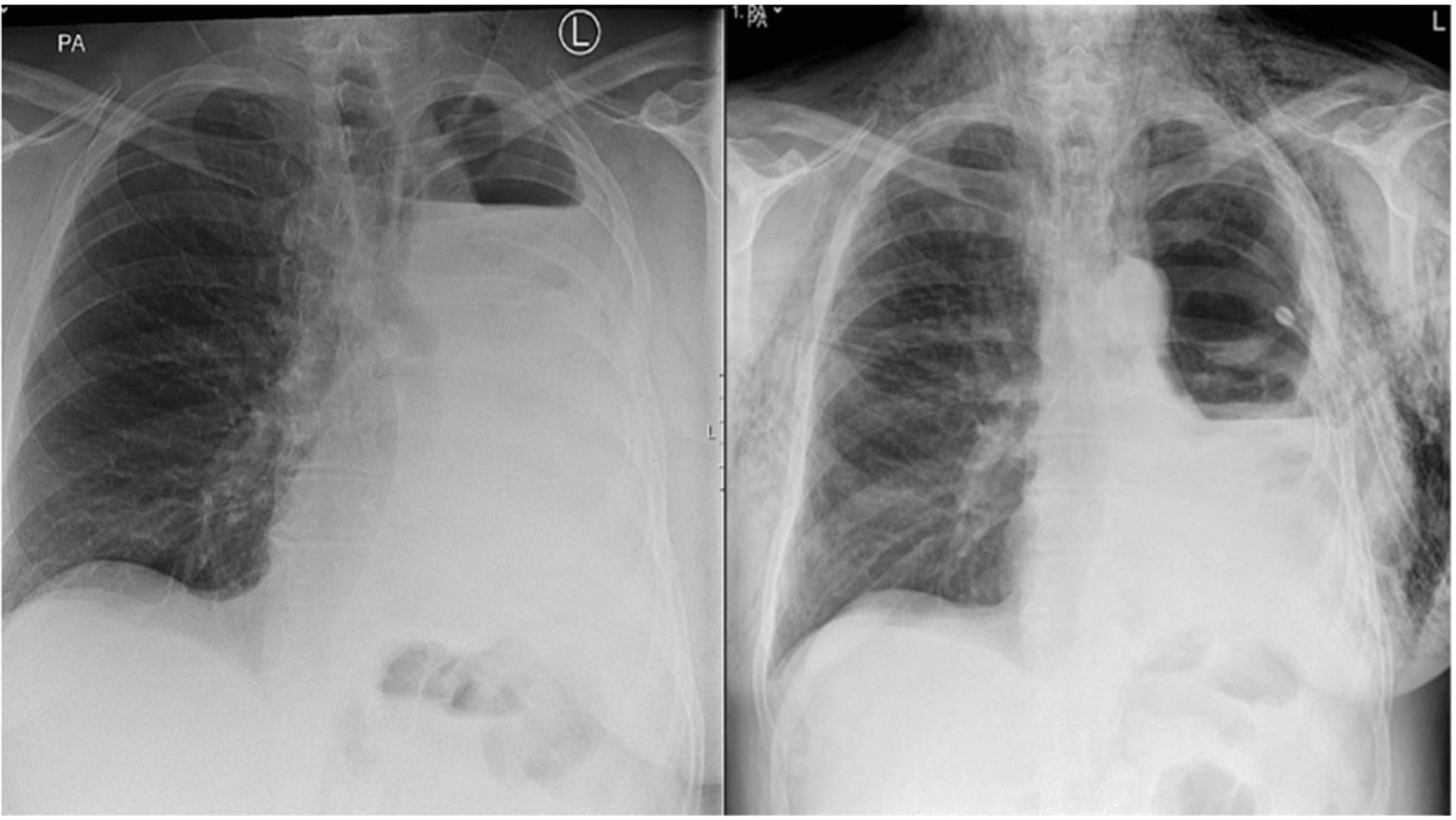 Successful Closure of Postpneumonectomy Bronchopleural Fistula With