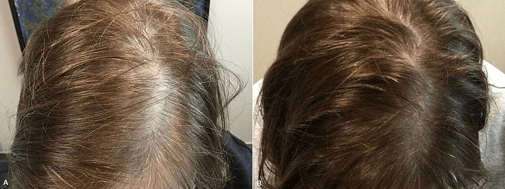 Female-patient-before-(A)-and-one-month-after-three-platelet-rich-plasma-treatments-(B)