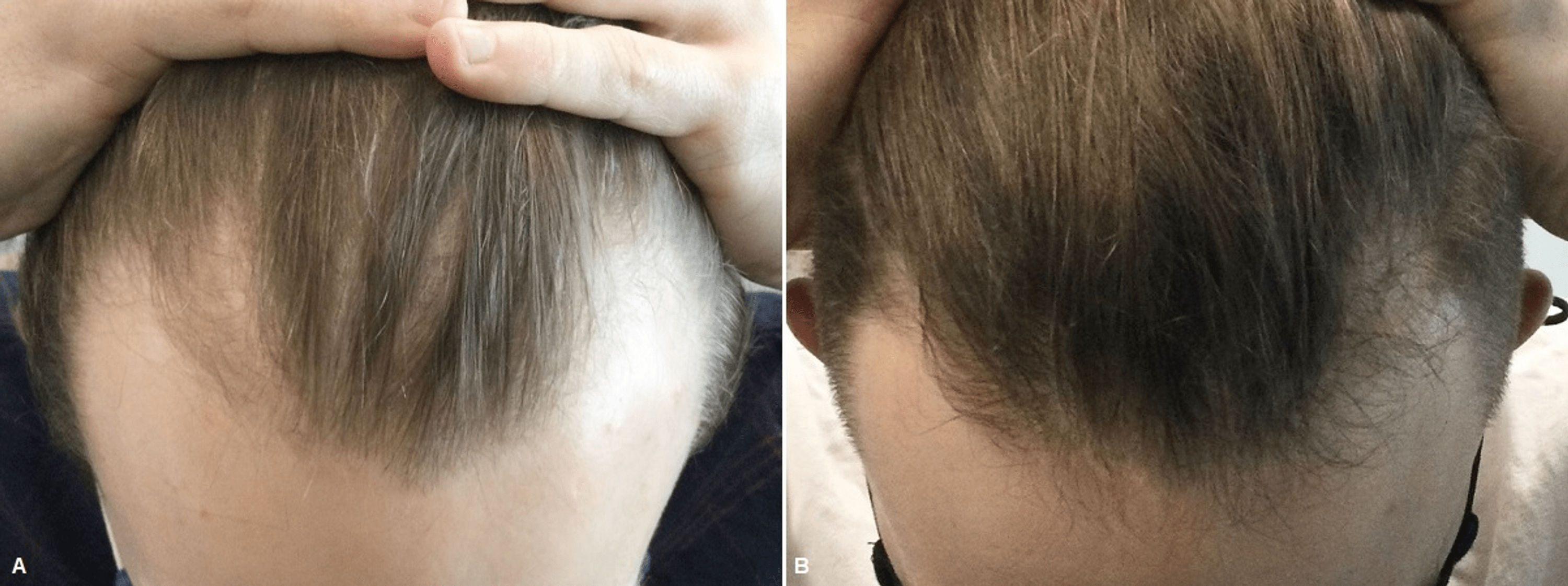 Cureus | Patient Satisfaction and Clinical Effects of Platelet-Rich Plasma  on Pattern Hair Loss in Male and Female Patients | Article