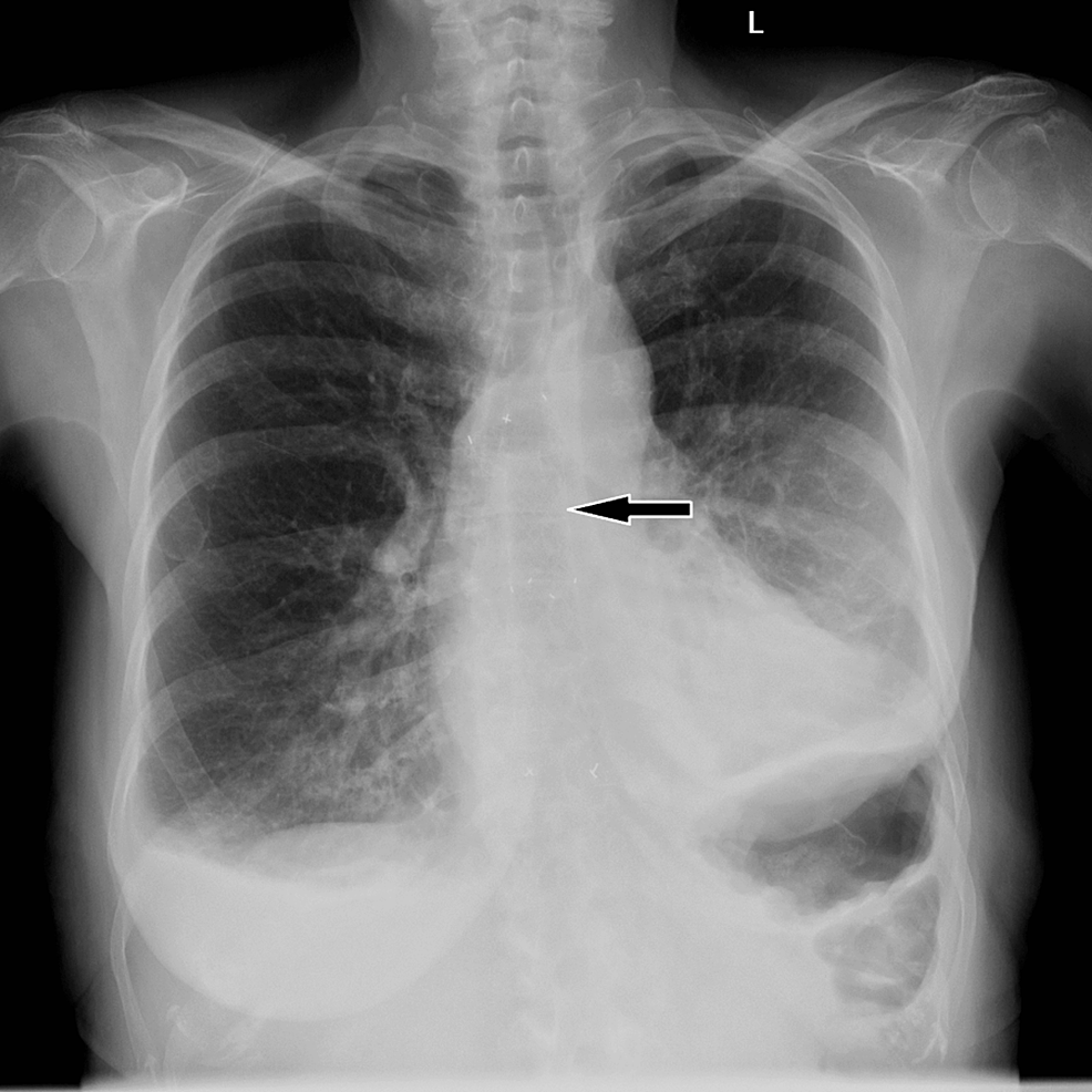 Cureus Small Bowel Obstruction Secondary To Migration Of A Fractured