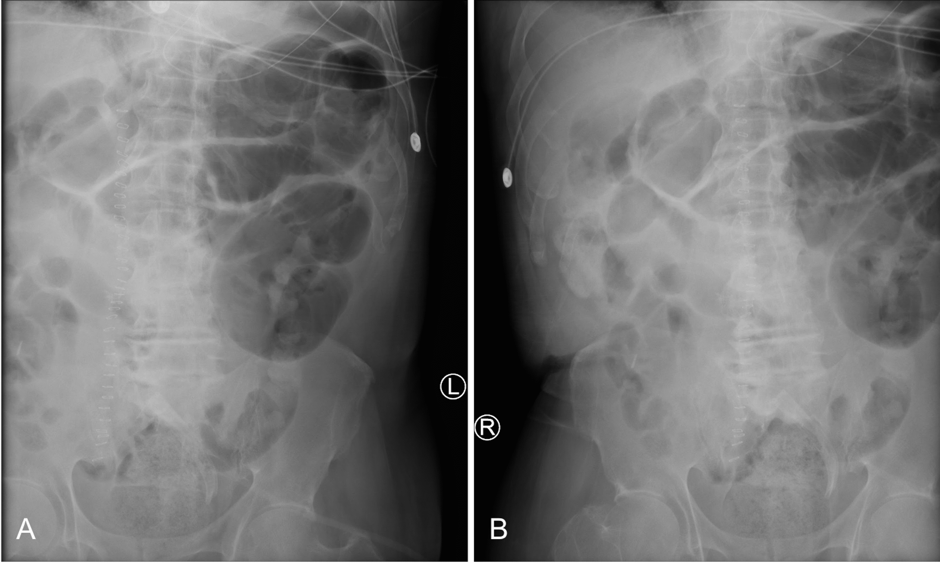 Simultaneous Sigmoid Volvulus and Small Bowel Obstruction: A Case ...