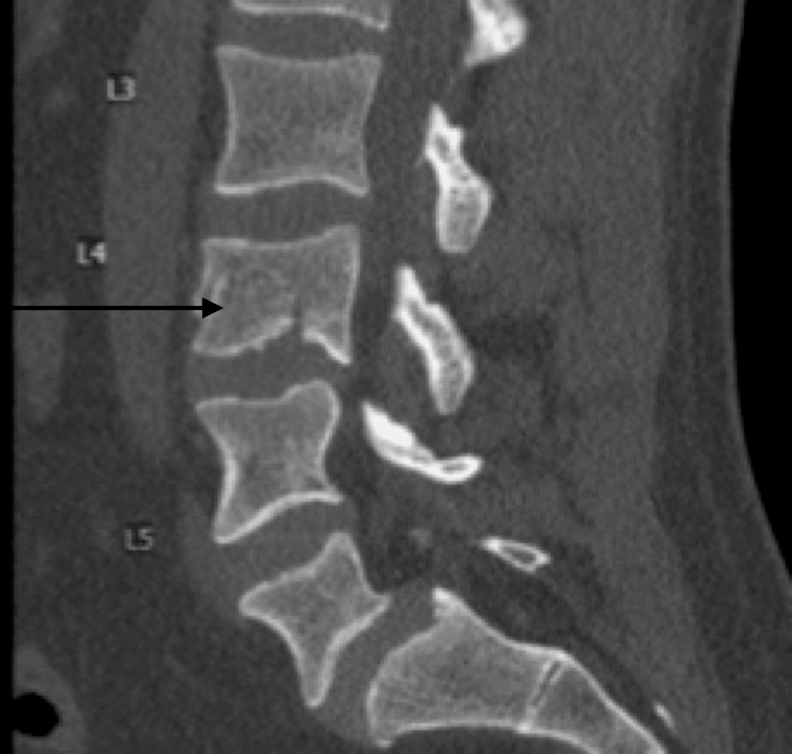 Cureus Nonoperative Management In Intact Burst Fracture Patient With Thoracolumbar Injury
