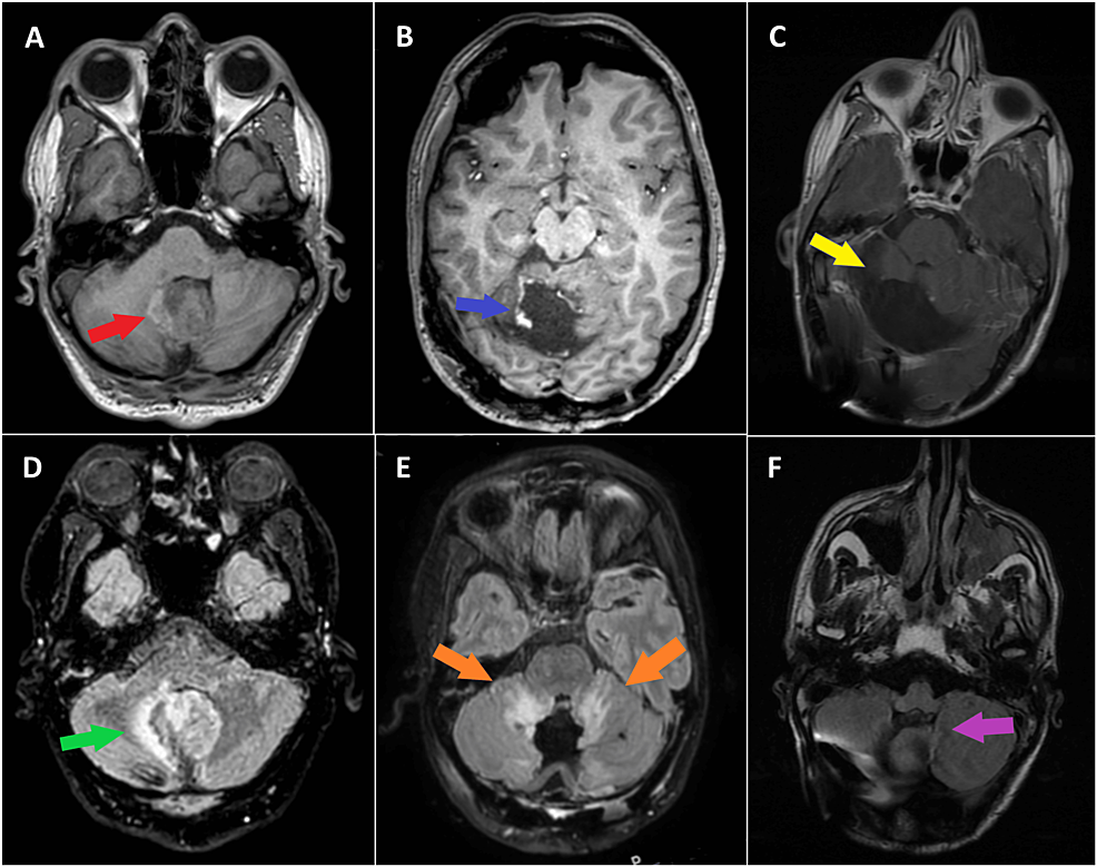 mri glutathione level tumor Larotrectinib in NTRK Fusion-Positive High-Grade Glioneuronal Tumor: A Case Report Gout is a form KEIFEITB500 Option:Glutathione