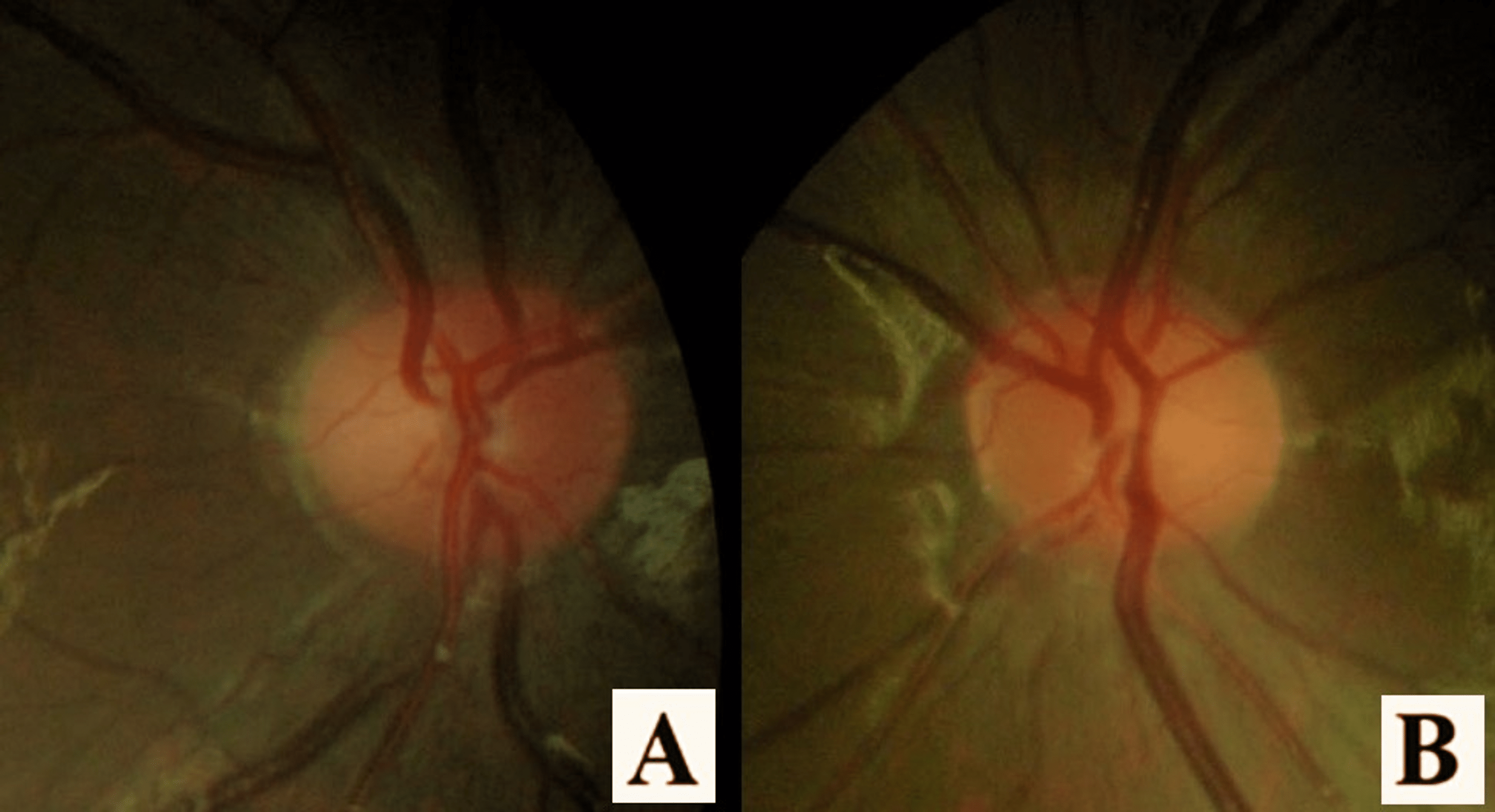 Cureus Bilateral Parainfectious Optic Neuritis in Young Patient