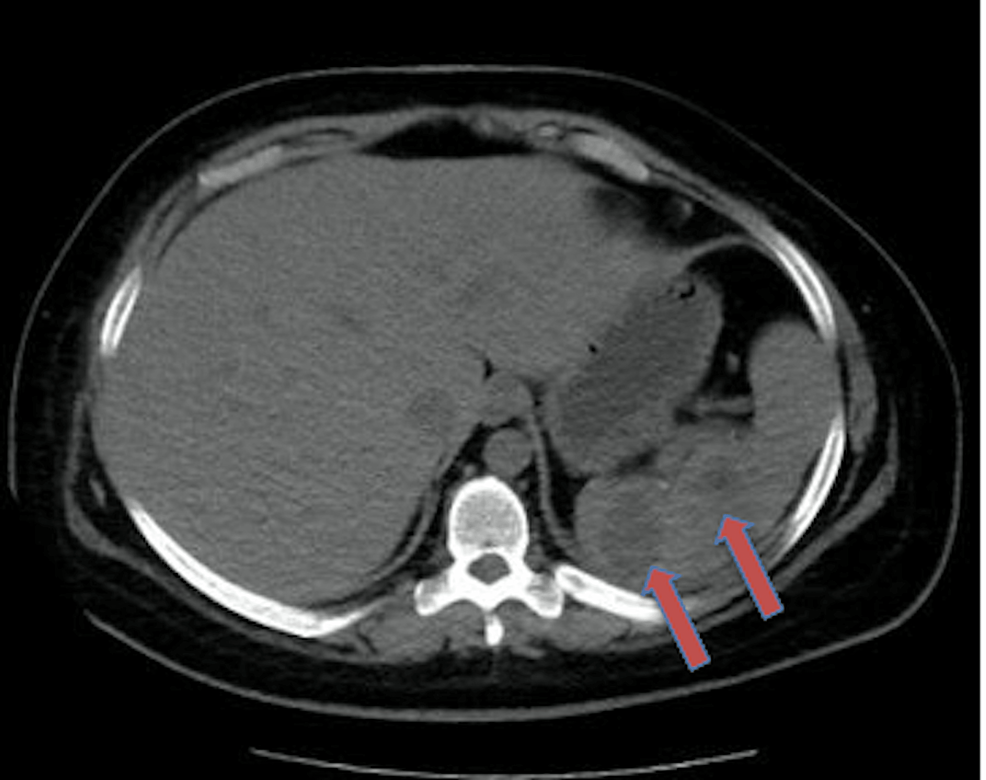 Surgical Management Of A Splenic Abscess Case Report Management And   Article River 6c3f513018cb11ed82cd638f8a7b4664 CT Spleen 