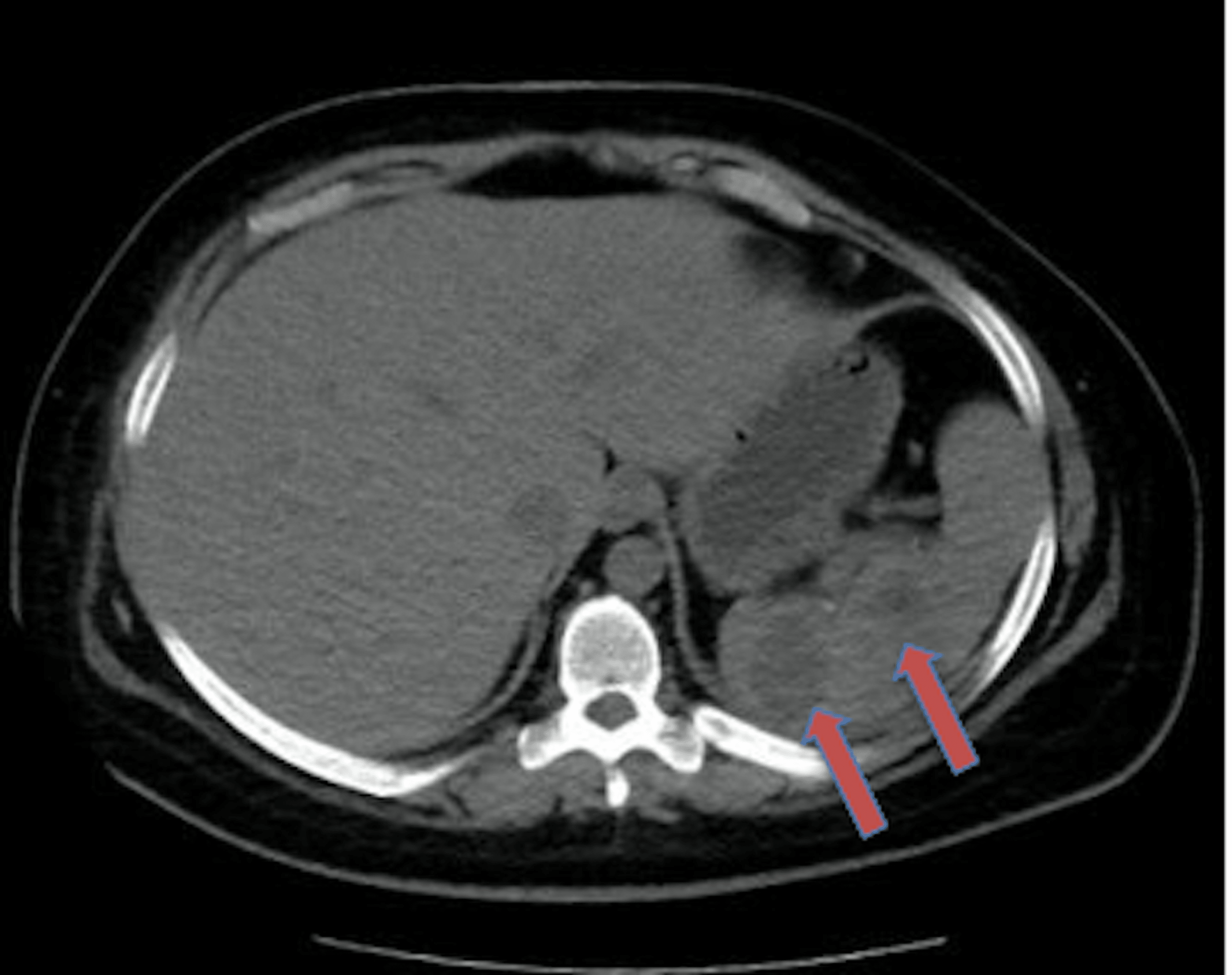 Cureus Surgical Management Of A Splenic Abscess Case Report Management And Review Of Literature