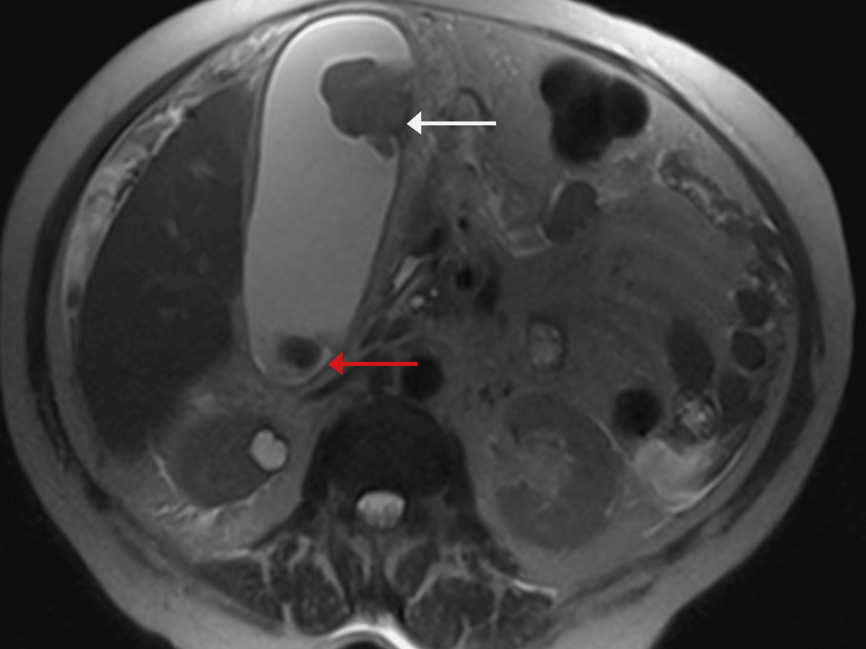 Cureus Rare Case of Gallbladder Neuroendocrine Carcinoma