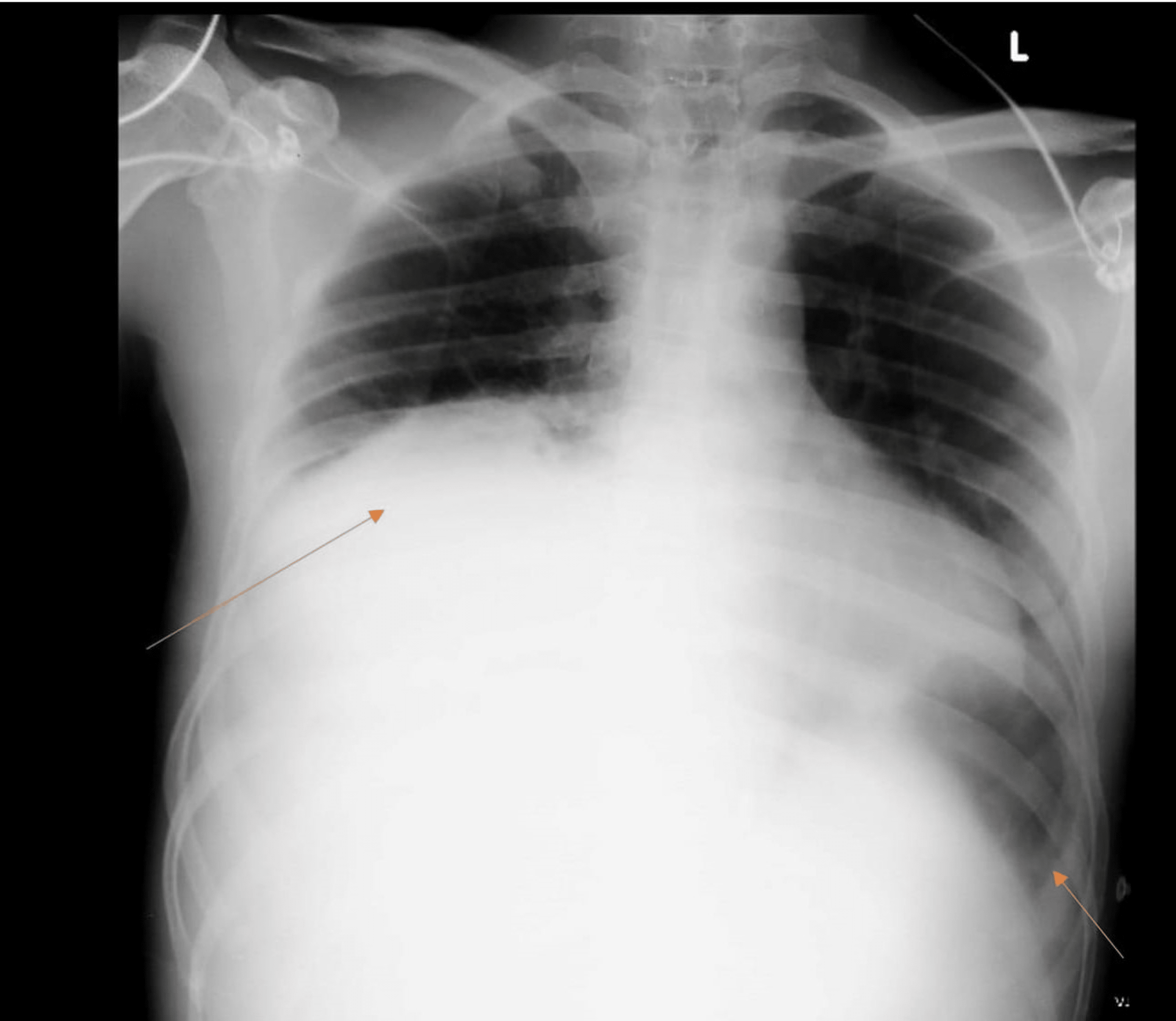 Cureus A Case of Amoebic Liver Abscess Presenting as a Therapeutic